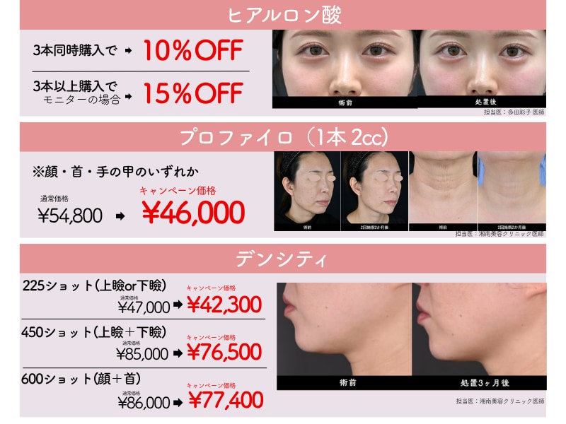 湘南美容クリニック　池袋西口院　4月　キャンペーン　安い　ヒアルロン酸　若返り　プロフファイロ　デンシティ たるみ　症例